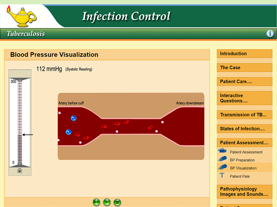 Illustration of the brachial artery reopening after having blood flow occluded by the cuff, and systolic reading showing on the sphygmomanometer