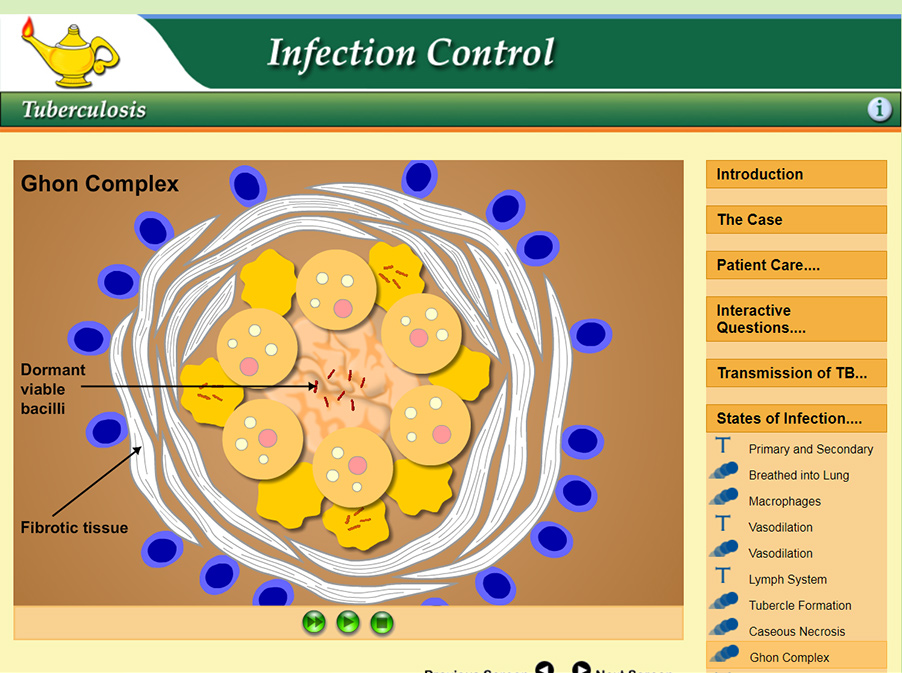 Illustration of a Ghon complex showing fibrotic tissue surrounding a tubercle with dormant viable Mycobacterium tuberculosis